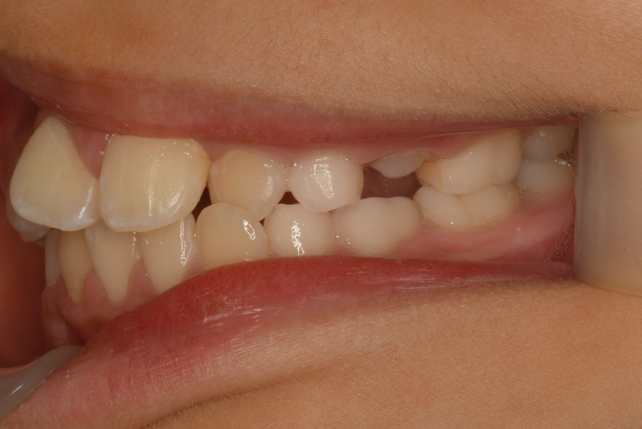 <br />
<b>Warning</b>:  Undefined variable $img_field_leftt_before in <b>/home/dostand/aiai-dental-clinic.jp/public_html/wp-content/themes/aiai-wp/archive-case.php</b> on line <b>196</b><br />
<br />
<b>Warning</b>:  Trying to access array offset on value of type null in <b>/home/dostand/aiai-dental-clinic.jp/public_html/wp-content/themes/aiai-wp/archive-case.php</b> on line <b>196</b><br />
