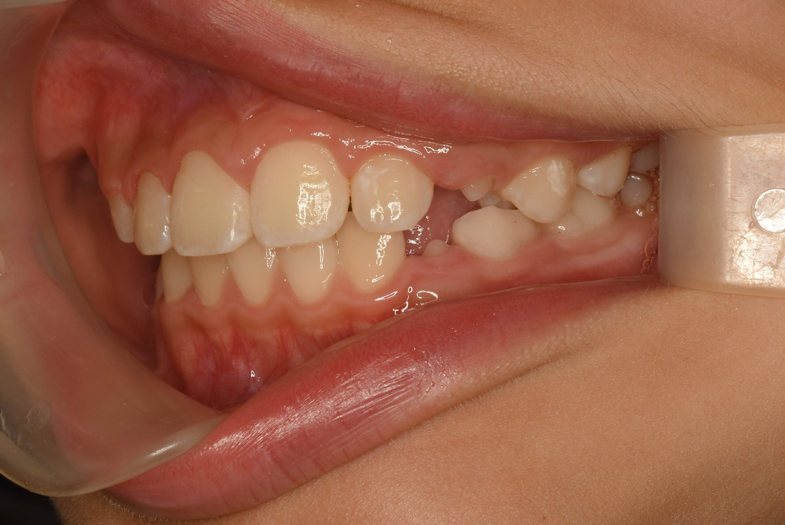 <br />
<b>Warning</b>:  Undefined variable $img_field_leftt_after in <b>/home/dostand/aiai-dental-clinic.jp/public_html/wp-content/themes/aiai-wp/archive-case.php</b> on line <b>237</b><br />
<br />
<b>Warning</b>:  Trying to access array offset on value of type null in <b>/home/dostand/aiai-dental-clinic.jp/public_html/wp-content/themes/aiai-wp/archive-case.php</b> on line <b>237</b><br />
