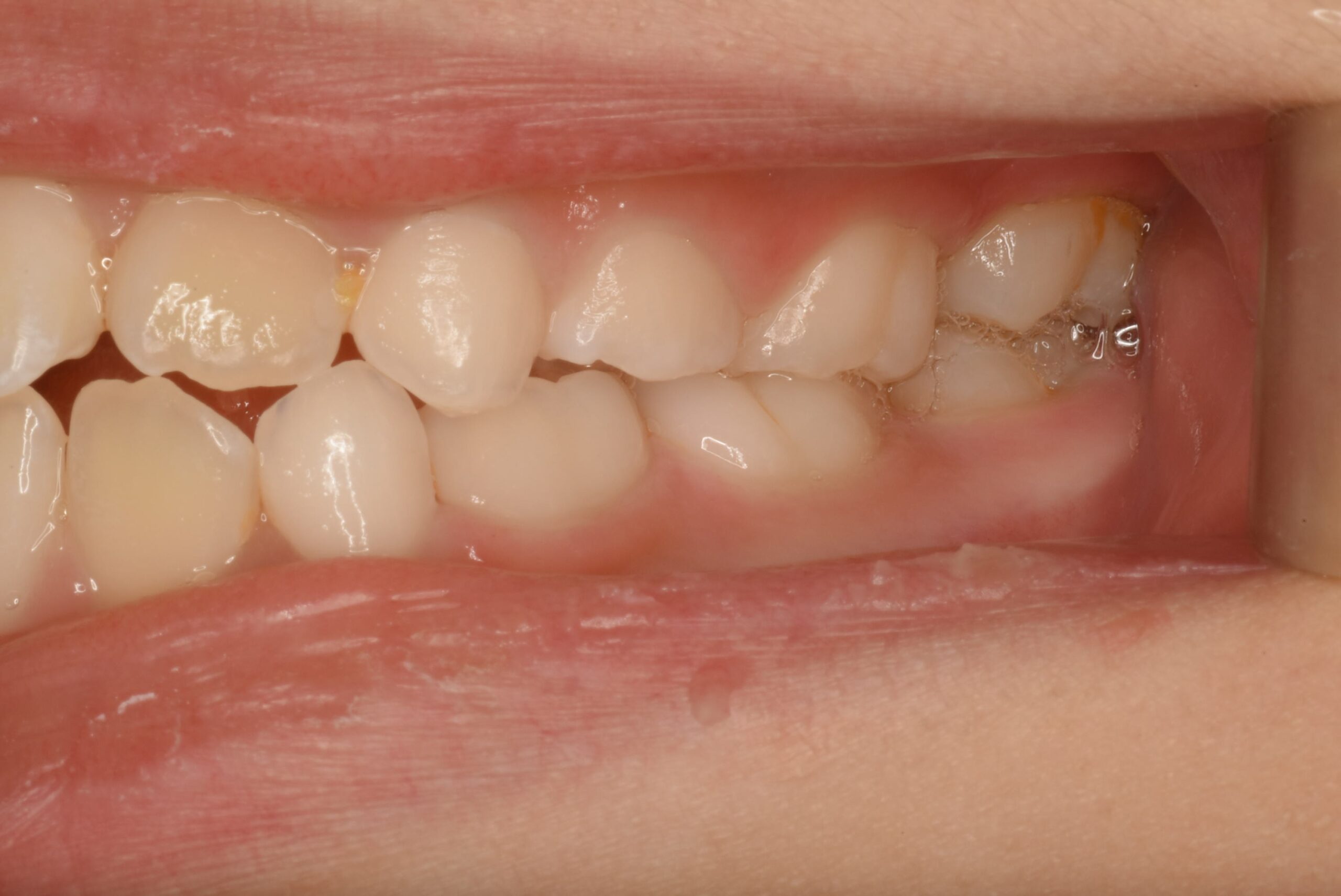 <br />
<b>Warning</b>: Undefined variable $img_field_leftt_before in <b>/home/dostand/aiai-dental-clinic.jp/public_html/wp-content/themes/aiai-wp/archive-case.php</b> on line <b>196</b><br />
<br />
<b>Warning</b>: Trying to access array offset on value of type null in <b>/home/dostand/aiai-dental-clinic.jp/public_html/wp-content/themes/aiai-wp/archive-case.php</b> on line <b>196</b><br />