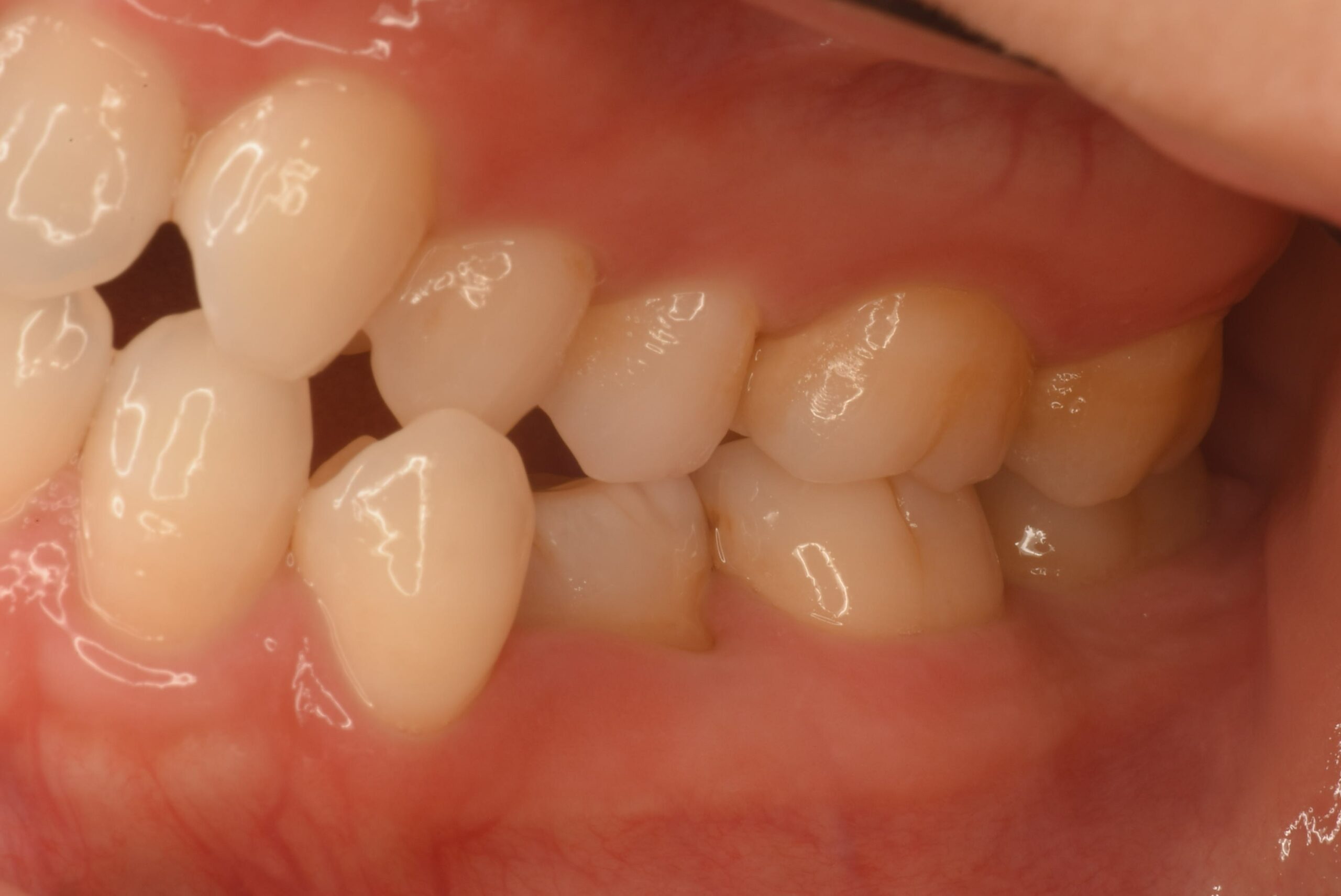 <br />
<b>Warning</b>:  Undefined variable $img_field_leftt_before in <b>/home/dostand/aiai-dental-clinic.jp/public_html/wp-content/themes/aiai-wp/archive-case.php</b> on line <b>196</b><br />
<br />
<b>Warning</b>:  Trying to access array offset on value of type null in <b>/home/dostand/aiai-dental-clinic.jp/public_html/wp-content/themes/aiai-wp/archive-case.php</b> on line <b>196</b><br />
