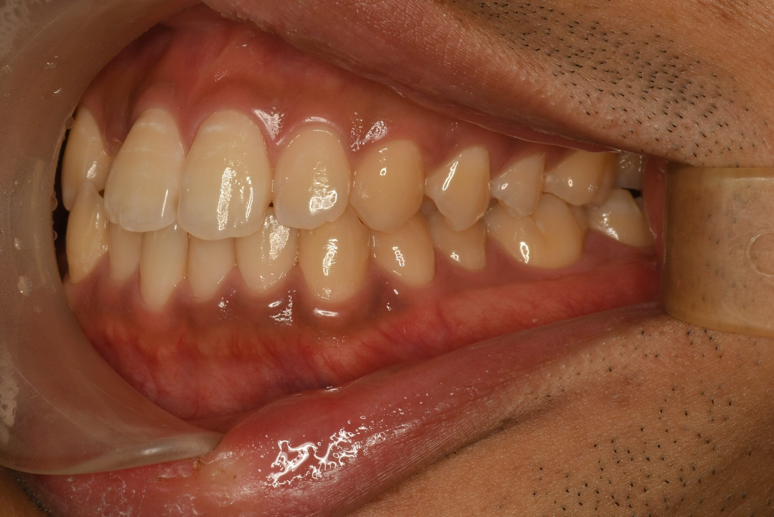 <br />
<b>Warning</b>:  Undefined variable $img_field_leftt_before in <b>/home/dostand/aiai-dental-clinic.jp/public_html/wp-content/themes/aiai-wp/archive-case.php</b> on line <b>196</b><br />
<br />
<b>Warning</b>:  Trying to access array offset on value of type null in <b>/home/dostand/aiai-dental-clinic.jp/public_html/wp-content/themes/aiai-wp/archive-case.php</b> on line <b>196</b><br />
