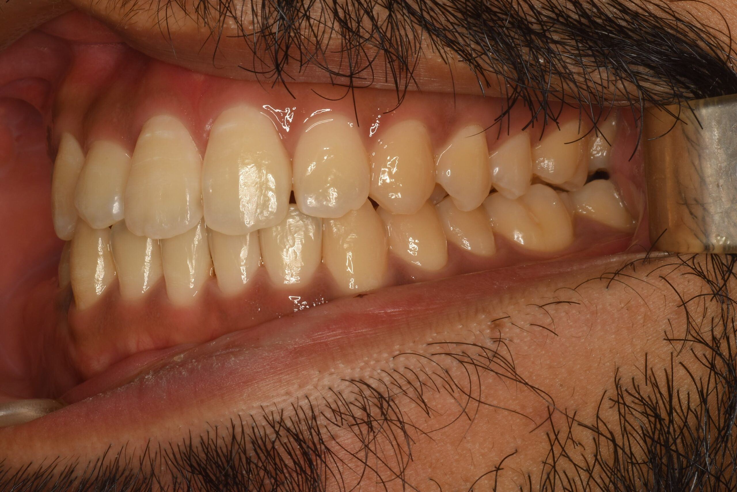 <br />
<b>Warning</b>:  Undefined variable $img_field_leftt_after in <b>/home/dostand/aiai-dental-clinic.jp/public_html/wp-content/themes/aiai-wp/archive-case.php</b> on line <b>237</b><br />
<br />
<b>Warning</b>:  Trying to access array offset on value of type null in <b>/home/dostand/aiai-dental-clinic.jp/public_html/wp-content/themes/aiai-wp/archive-case.php</b> on line <b>237</b><br />
