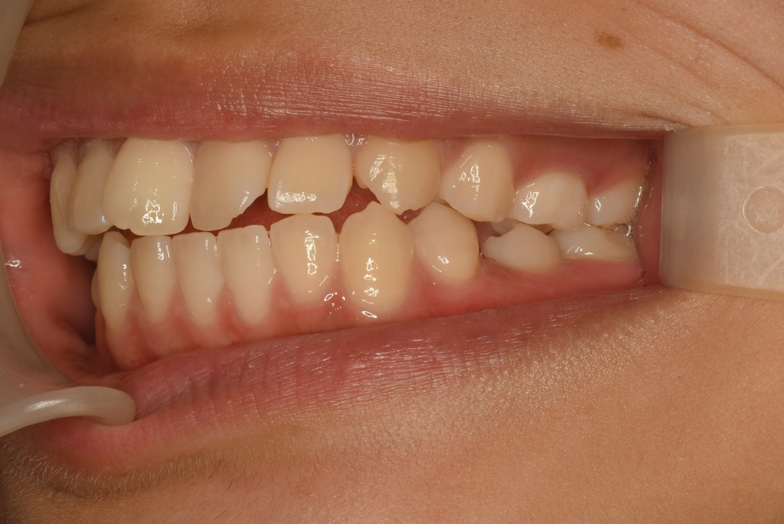 <br />
<b>Warning</b>:  Undefined variable $img_field_leftt_before in <b>/home/dostand/aiai-dental-clinic.jp/public_html/wp-content/themes/aiai-wp/taxonomy-case-cat2.php</b> on line <b>182</b><br />
<br />
<b>Warning</b>:  Trying to access array offset on value of type null in <b>/home/dostand/aiai-dental-clinic.jp/public_html/wp-content/themes/aiai-wp/taxonomy-case-cat2.php</b> on line <b>182</b><br />
