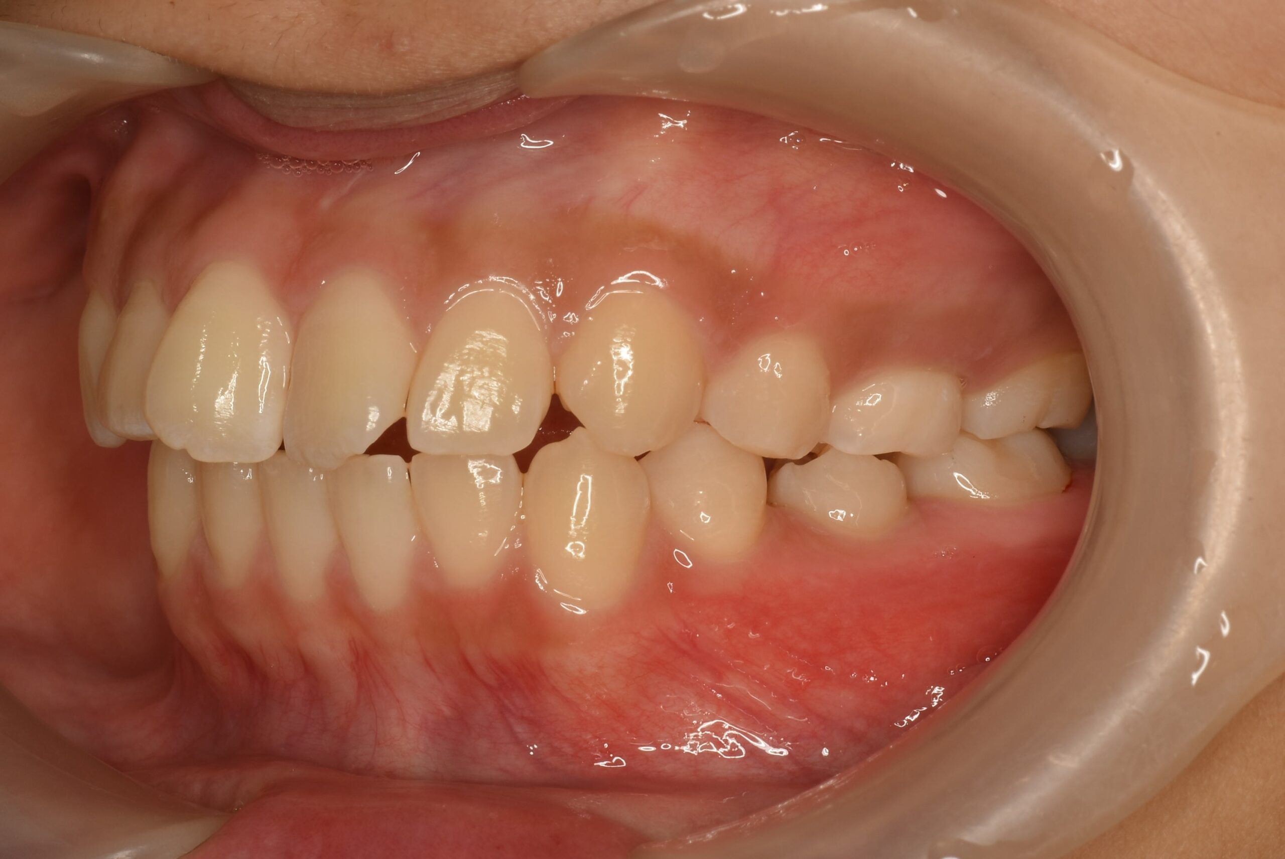 <br />
<b>Warning</b>:  Undefined variable $img_field_leftt_after in <b>/home/dostand/aiai-dental-clinic.jp/public_html/wp-content/themes/aiai-wp/taxonomy-case-cat2.php</b> on line <b>223</b><br />
<br />
<b>Warning</b>:  Trying to access array offset on value of type null in <b>/home/dostand/aiai-dental-clinic.jp/public_html/wp-content/themes/aiai-wp/taxonomy-case-cat2.php</b> on line <b>223</b><br />
